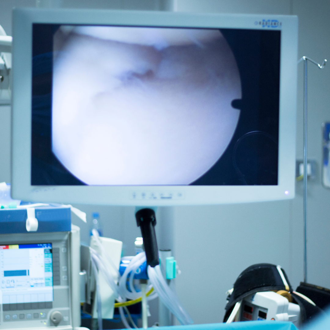 Arthroscopic Shoulder Repairs (Rotator Cuff, SLAP Tear, Instability)