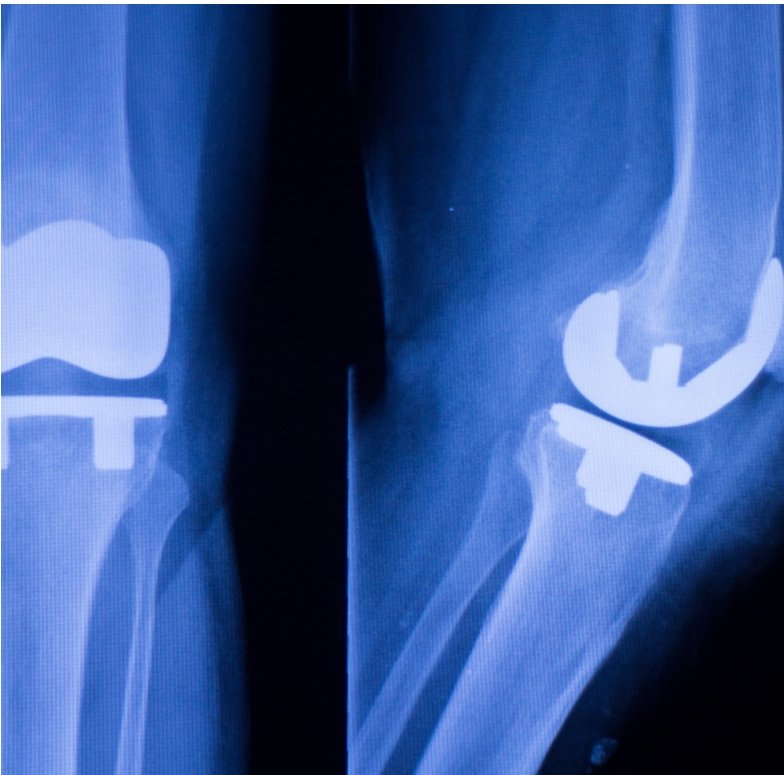Knee & Hip Replacement Surgeries