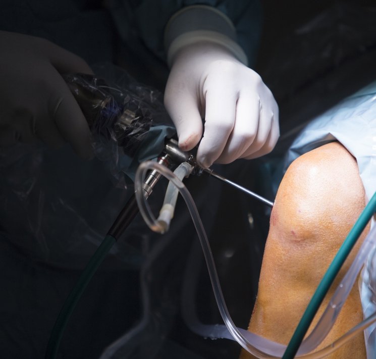 Arthroscopic ACL, PCL & Meniscus Repairs